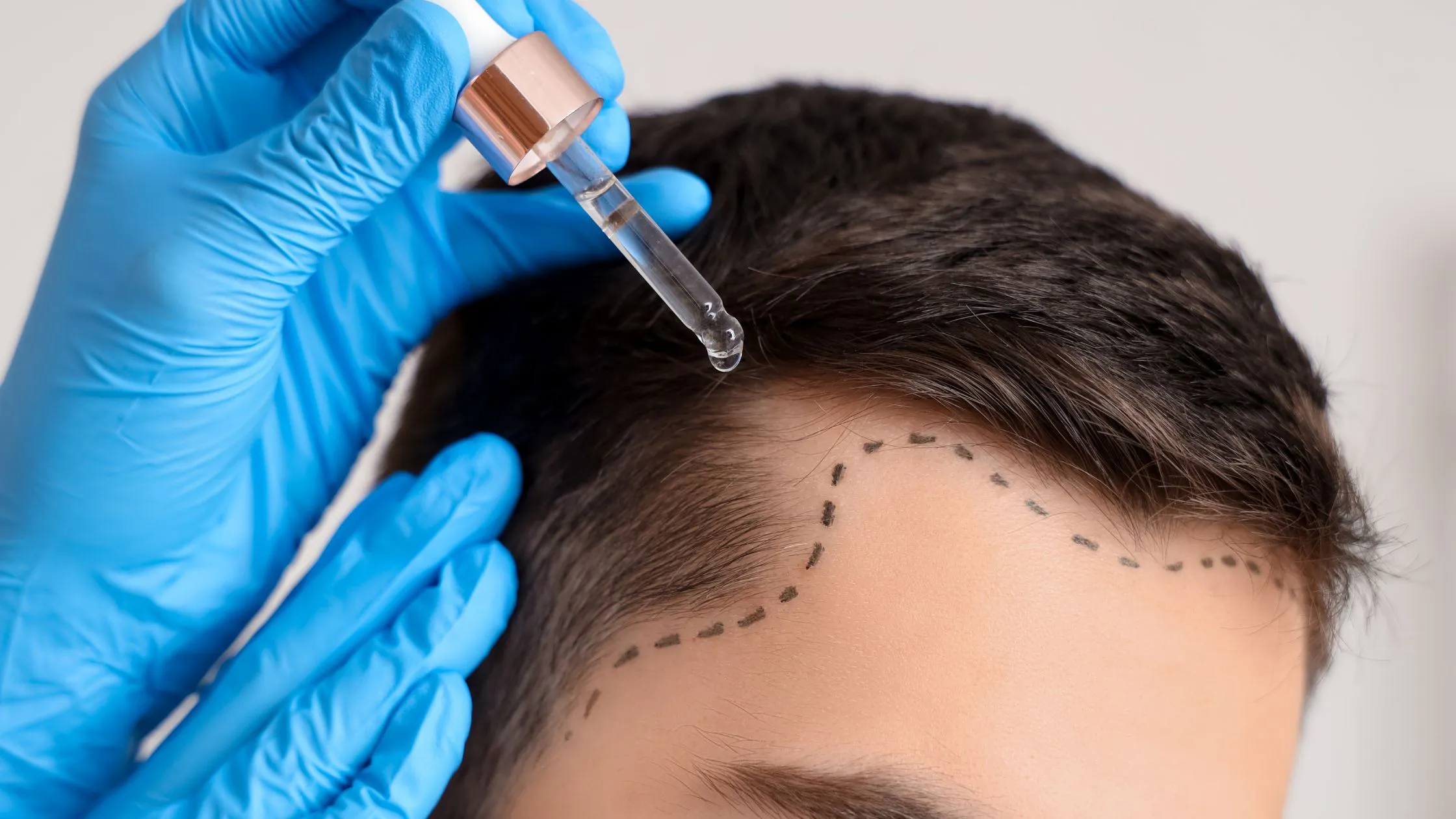 Medisinsk behandling av hårtap hos menn